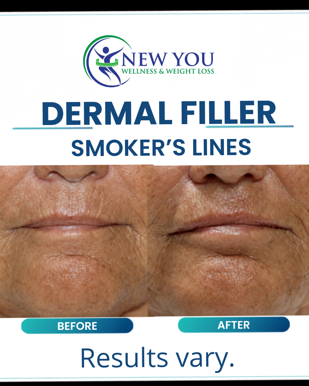 Before and after dermal filler treatment for smoker's lines